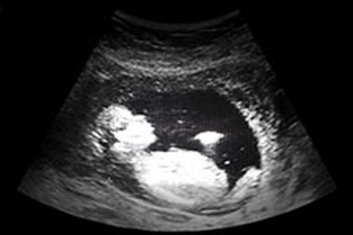 ultrasound image of unborn child